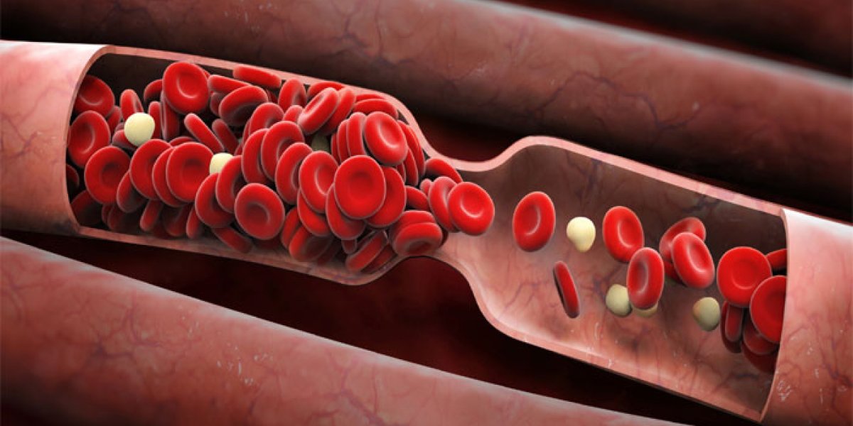 Тихий убийца: как тромб маскируется под обычную усталость