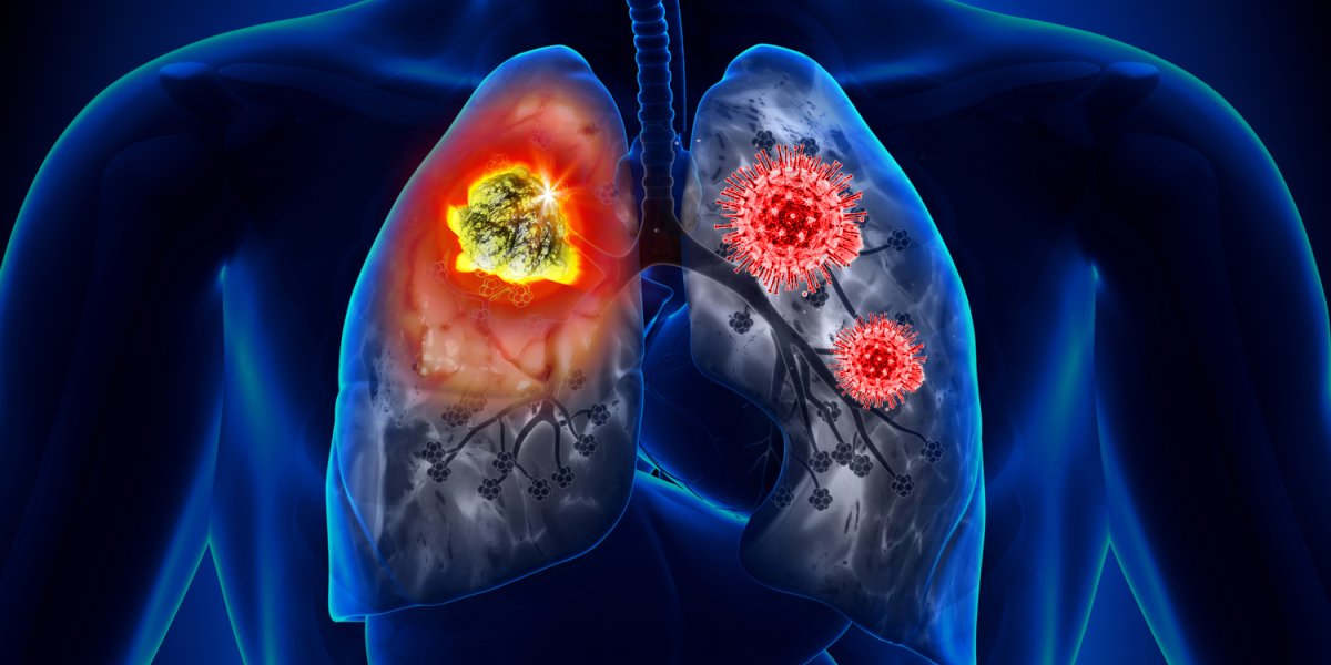Ученые обнаружили пусковой механизм рака легких: воспаление оказалось главным виновником Ученые обнаружили пусковой механизм рака легких: воспаление оказалось главным виновником